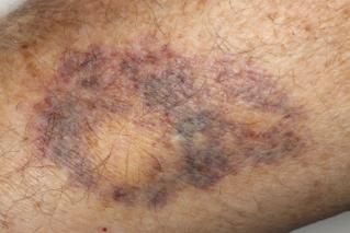Original Image - Bruise