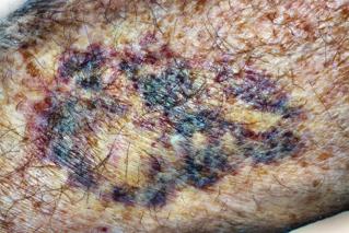 Filtered Image - Bruise